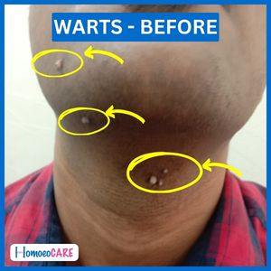 warts on beard area